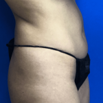 VASER Liposuction Hi-Def Before & After Patient #7942