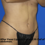 VASER Liposuction Hi-Def Before & After Patient #7942