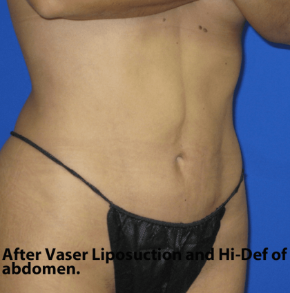 VASER Liposuction Hi-Def Before & After Patient #7942