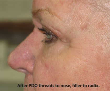 PDO Threads Before & After Patient #7970