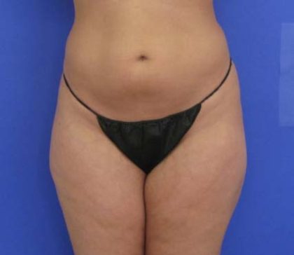 VASER Liposuction Before & After Patient #8026