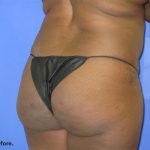 VASER Liposuction Before & After Patient #8051