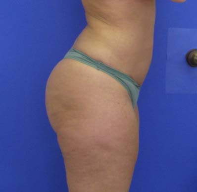 VASER Liposuction Before & After Patient #8026