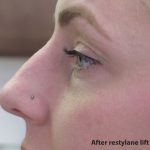 Non-Surgical Rhinoplasty Before & After Patient #8066