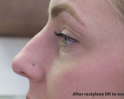 Non-Surgical Rhinoplasty Before & After Patient #8066