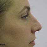 Non-Surgical Rhinoplasty Before & After Patient #8066