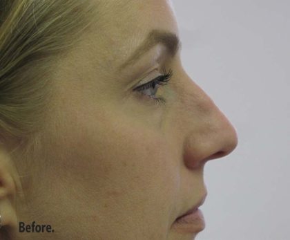 Non-Surgical Rhinoplasty Before & After Patient #8066