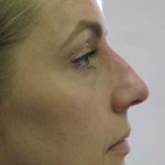 Non-Surgical Rhinoplasty Before & After Patient #8066