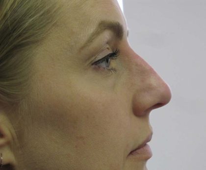 Non-Surgical Rhinoplasty Before & After Patient #8066