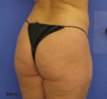 VASER Liposuction Before & After Patient #8026