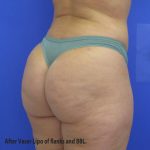 VASER Liposuction Before & After Patient #8026