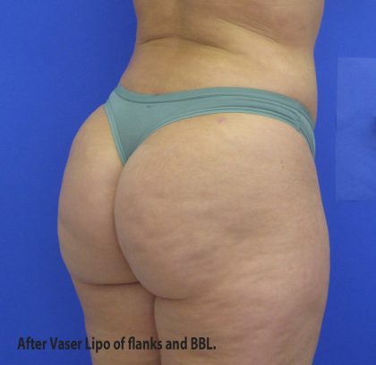 VASER Liposuction Before & After Patient #8026