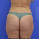 VASER Liposuction Before & After Patient #8026