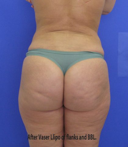 VASER Liposuction Before & After Patient #8026