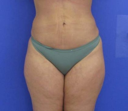 VASER Liposuction Before & After Patient #8026