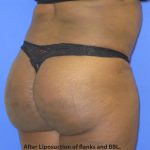 VASER Liposuction Before & After Patient #8051