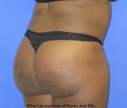 VASER Liposuction Before & After Patient #8051