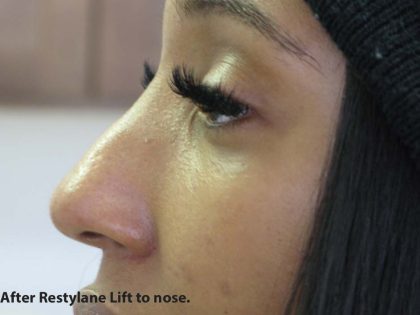 Non-Surgical Rhinoplasty Before & After Patient #8056