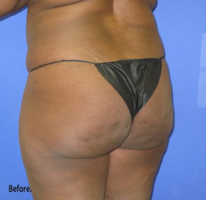 VASER Liposuction Before & After Patient #8051