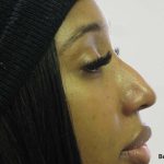 Non-Surgical Rhinoplasty Before & After Patient #8056