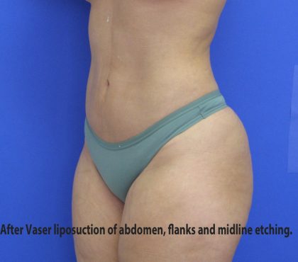 VASER Liposuction Before & After Patient #8026