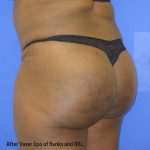 VASER Liposuction Before & After Patient #8051