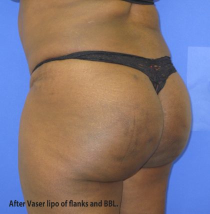 VASER Liposuction Before & After Patient #8051