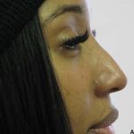 Non-Surgical Rhinoplasty Before & After Patient #8056