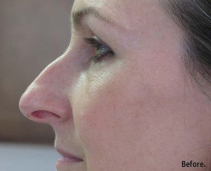 Non-Surgical Rhinoplasty Before & After Patient #8061