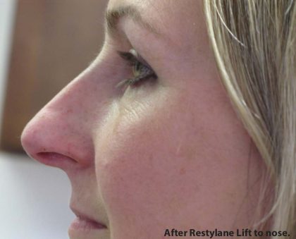 Non-Surgical Rhinoplasty Before & After Patient #8061