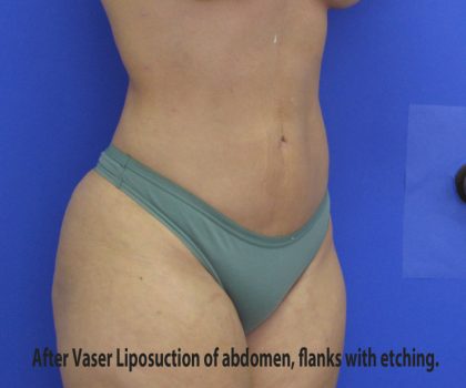 VASER Liposuction Before & After Patient #8026