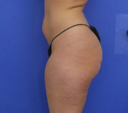 VASER Liposuction Before & After Patient #8026