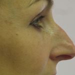 Non-Surgical Rhinoplasty Before & After Patient #8061