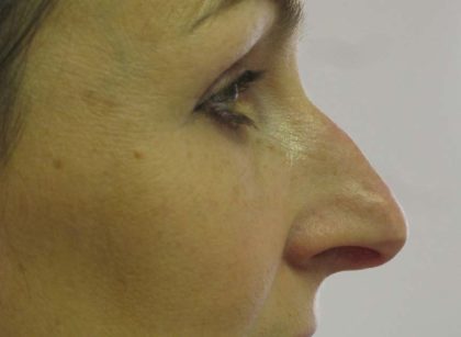 Non-Surgical Rhinoplasty Before & After Patient #8061