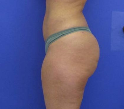 VASER Liposuction Before & After Patient #8026