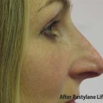 Non-Surgical Rhinoplasty Before & After Patient #8061