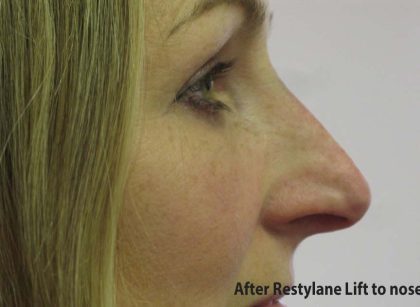 Non-Surgical Rhinoplasty Before & After Patient #8061