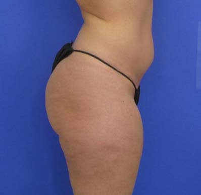 VASER Liposuction Before & After Patient #8026