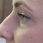 Non-Surgical Rhinoplasty Before & After Patient #8066