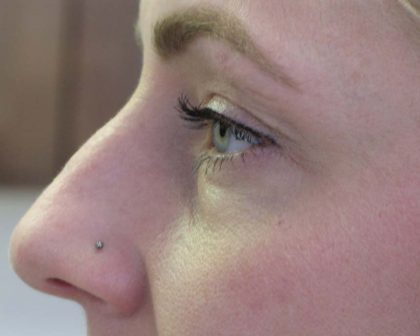 Non-Surgical Rhinoplasty Before & After Patient #8066