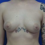 Breast Augmentation Before & After Patient #8113