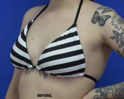Breast Augmentation Before & After Patient #8113