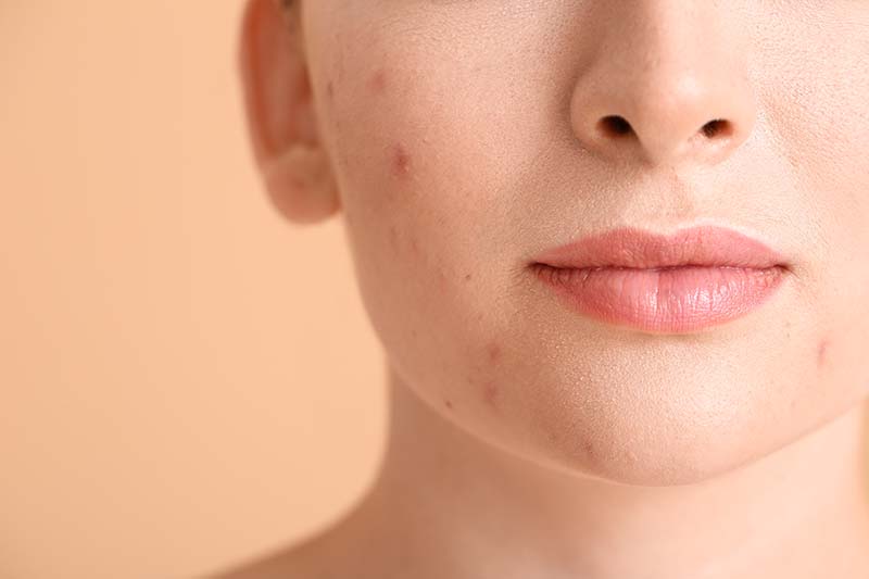 CROSS and Microneedling for Acne Scars