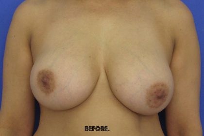 Breast Lift With Explantation Before & After Patient #8251