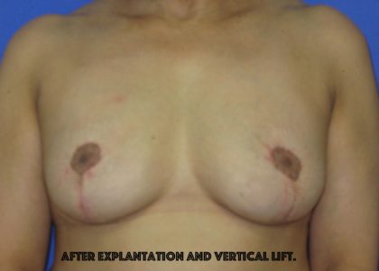 Breast Lift With Explantation Before & After Patient #8251