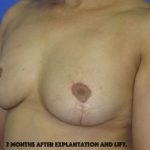 Breast Lift With Explantation Before & After Patient #8251