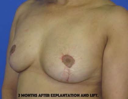 Breast Lift With Explantation Before & After Patient #8251