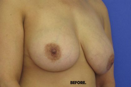 Breast Lift With Explantation Before & After Patient #8251