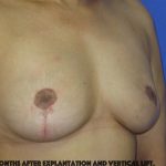 Breast Lift With Explantation Before & After Patient #8251