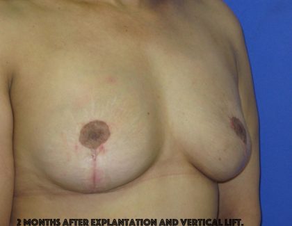 Breast Lift With Explantation Before & After Patient #8251